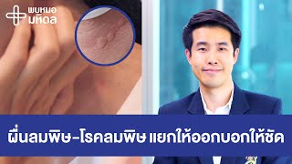 ผื่นลมพิษ ไม่เท่ากับ โรคลมพิษ แยกให้ออกบอกให้ชัด | พบหมอมหิดล