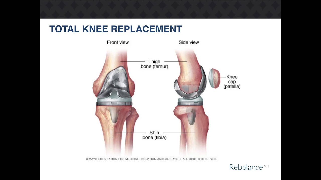 RebalanceMD Total Knee Replacement - YouTube