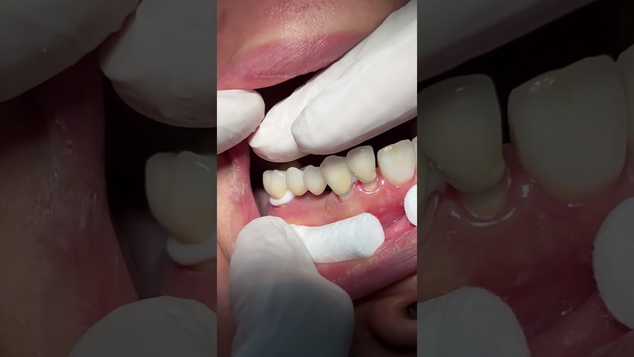 Porcelain Bridge To Replace Missing Teeth Satisfying