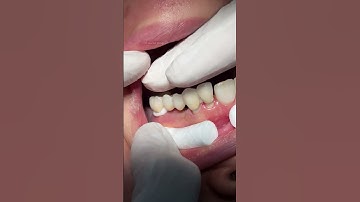 Porcelain bridge to replace missing teeth #satisfying