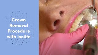 PFM Crown Removal Procedure on Tooth No. 18 with Zyis Isolite dental isolation system