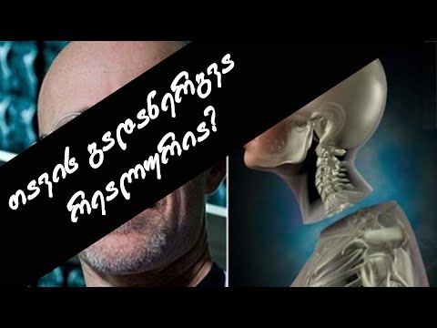 თავის გადანერგვა -  რამდენად რეალურია?