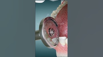 IPR Braces Orthodontic Treatment I CURVEIA  #shorts