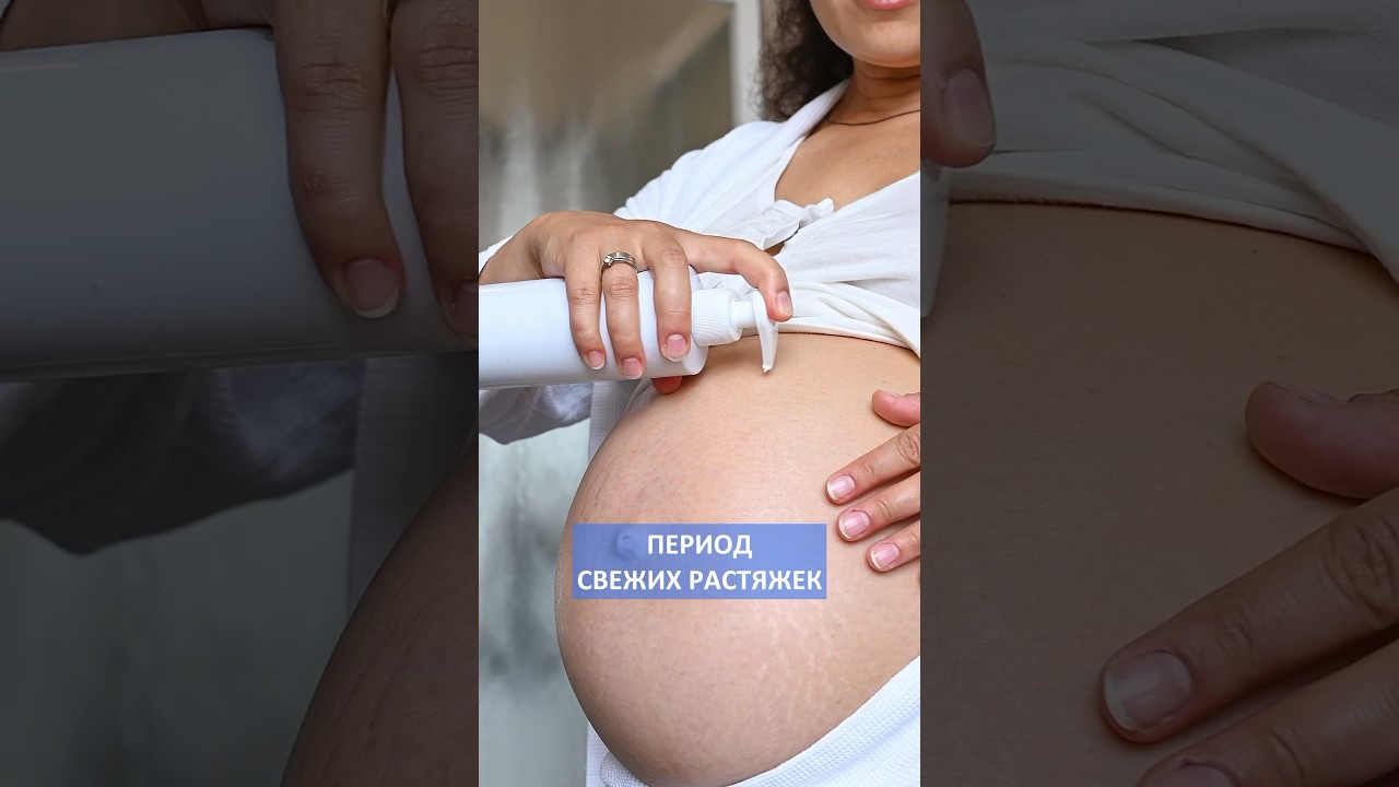 Лучшие средства от растяжек для ВСЕХ ЖЕНЩИН - при беременности и до беременности #растяжки #кожа