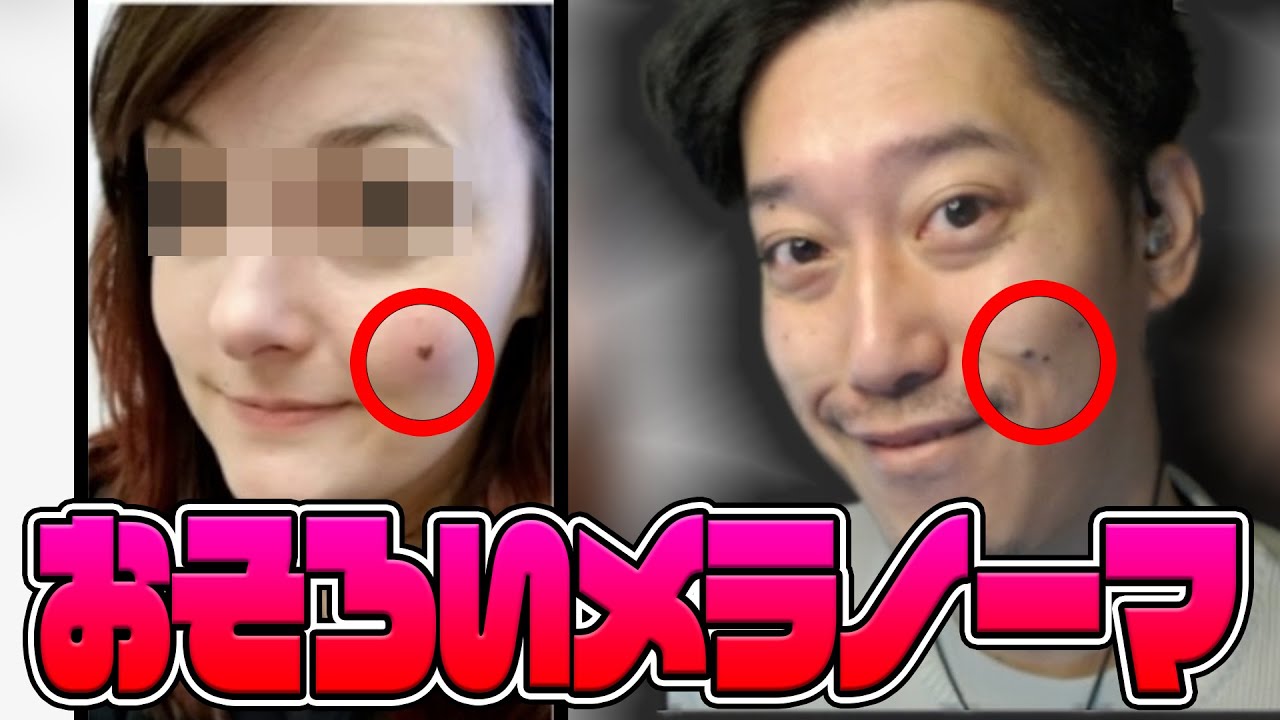 ハート型メラノーマの女性と同じ位置にメラノーマを所持する布団ちゃん 21 11 25 Youtube
