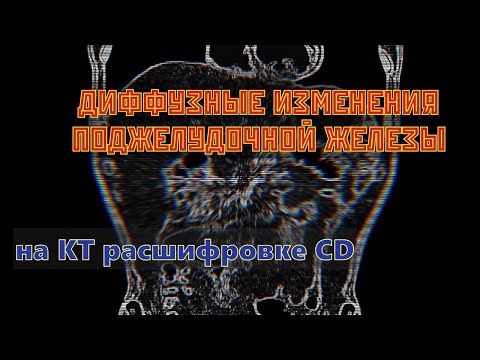ДИФФУЗНЫЕ ИЗМЕНЕНИЯ ПОДЖЕЛУДОЧНОЙ ЖЕЛЕЗЫ на расшифровке КТ брюшной полости