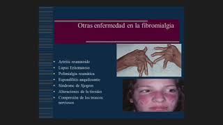 Discapacidad en la fibromialgia asociada a depresión y ansiedad