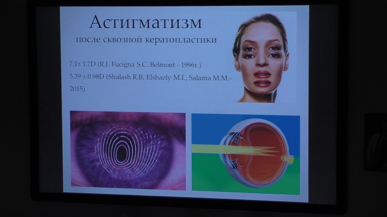 Хирургическое лечение кератоконуса - YouTube