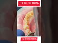 Shorts youtubeshorts teeth cleaning procedure