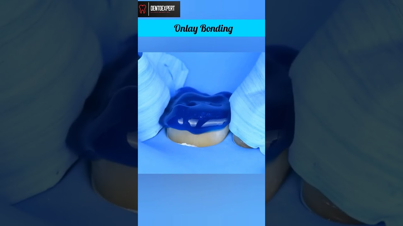 Molar Onlay Etching & Bonding | Onlay Bonding Procedure🦷