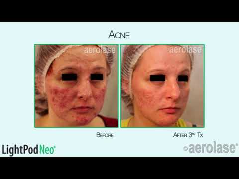 Acne Treatment with Aerolase Laser