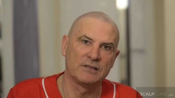 Scalp Micropigmentation at Scalp Clinic - Martin