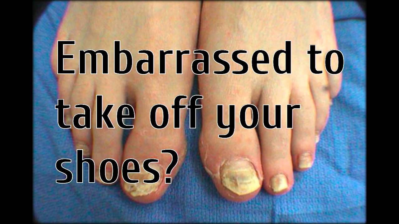 onycholysis treatment YouTube