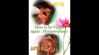 How to be Virgin again : Hymenoplasty by Dr. Avijit Basak