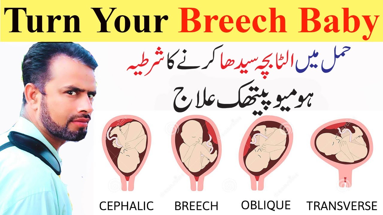 breech presentation homeopathic medicine