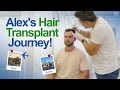 Hair Transplant in Istanbul Review: This Australian Visits Turkey for Hair Restoration!