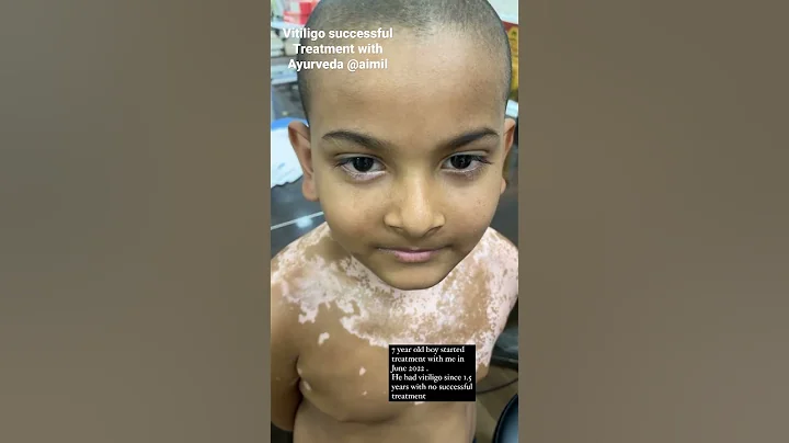 Vitiligo recovery with Dr Nitika kohli  #ayurvedaeveryday - DayDayNews