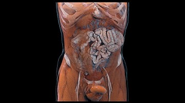 Ehlers-Danlos-Syndrome - CT UHQ rendering