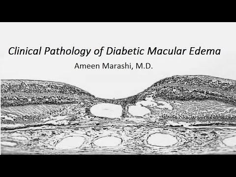 Clinical pathology of Diabetic Macular Edema