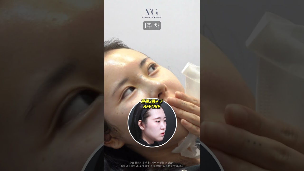 [美好整形外科診所] 人生只有一次，活得漂亮吧✨ #輪廓三項 #鼻部手術 #臉部輪廓