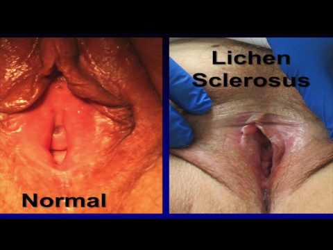 Pictures Of Lichen Sclerosus - ACOG full version Muffly Vulvar Dermatosis 10.9.2016