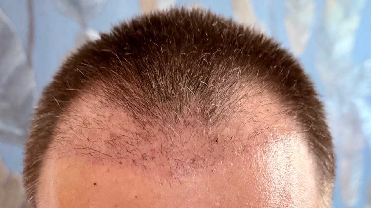 1. Update der Haartransplantation, 5 Wochen danach 