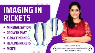 Imaging in Rickets Simplified | Dr. Sony KM AIR 9 | Docemy 💜 screenshot 2