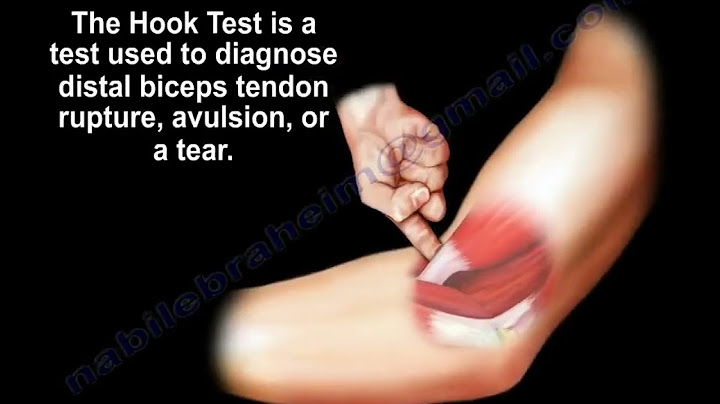Distal biceps tendon tear,