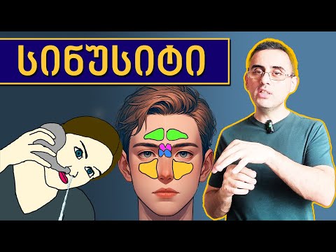 სინუსიტის ნიშნები, მიზეზები და მკურნალობა