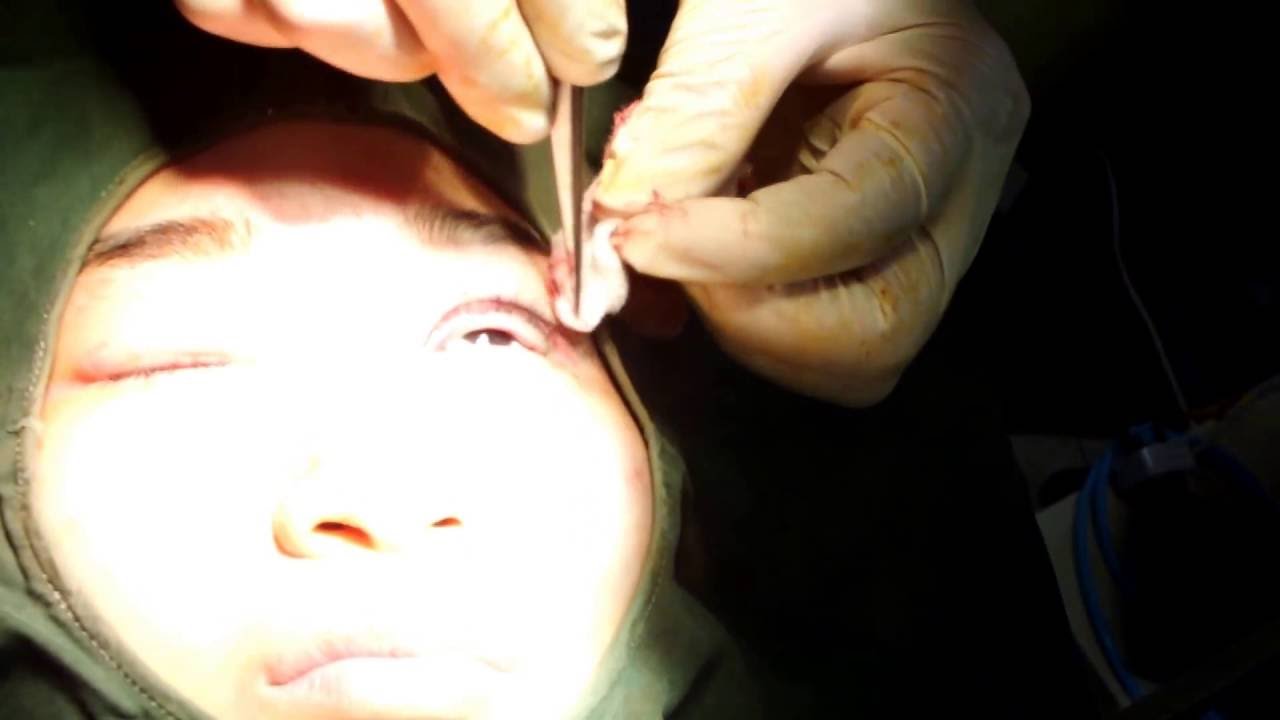 Lazy Eye Correction completed operation - YouTube