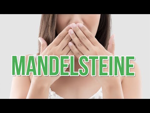 Video: 3 Möglichkeiten, Tonsillensteine zu verhindern