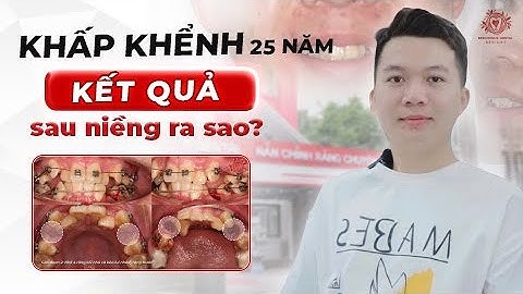 Kết Quả Niềng Răng Khấp Khểnh Nặng Sau 2 Năm Sẽ Như Thế Nào?| Nha khoa Đặng Xá - S-Dental