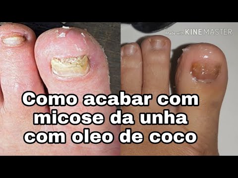 Vídeo: O óleo De Coco Para Micose Funciona? Como Usar Este Tratamento