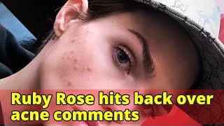 Ruby Rose hits back over acne comments