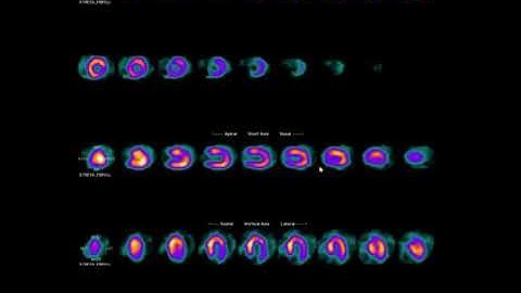 Nuclear Stress Test Reading