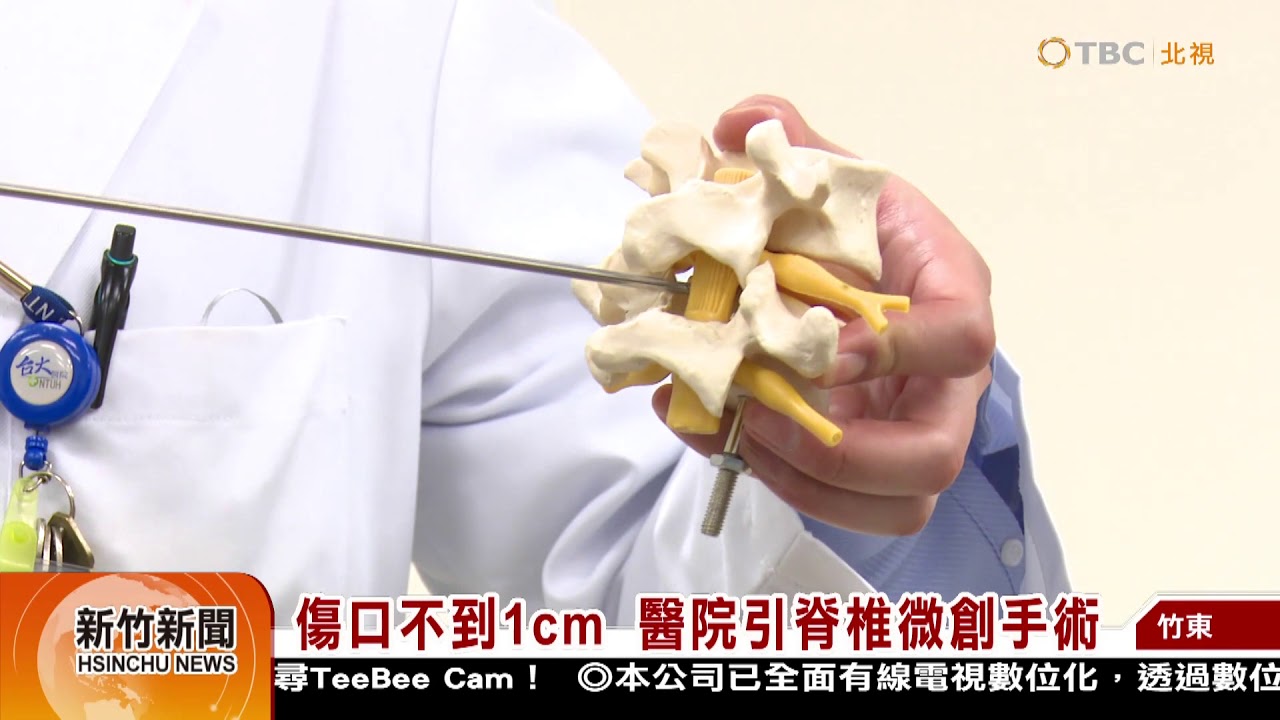 脊椎微創內視鏡手術(舊稱:經皮脊椎內視鏡手術, PELD) 縮圖