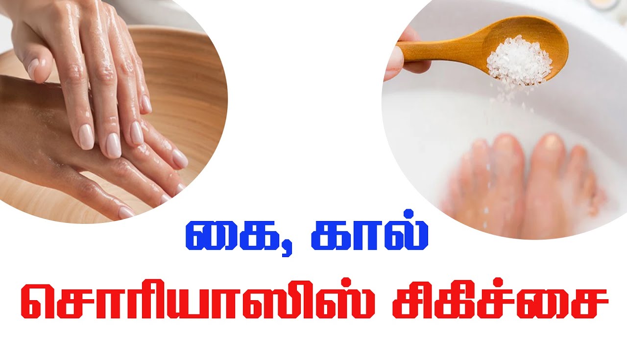 கை,கால்களில் வருகின்ற சொரியாசிஸ் சிகிச்சை | JKT SKIN  