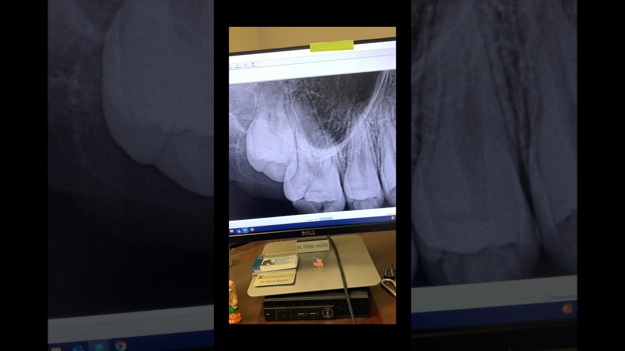 THIS 12-year old needed a root canal on tooth #3. 