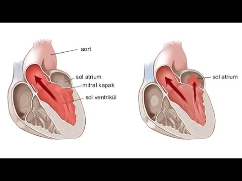 Mitral Kapak Proplapsusu Nedir ? -Doç. Dr. Hüseyin Arınç - Dora Hospital