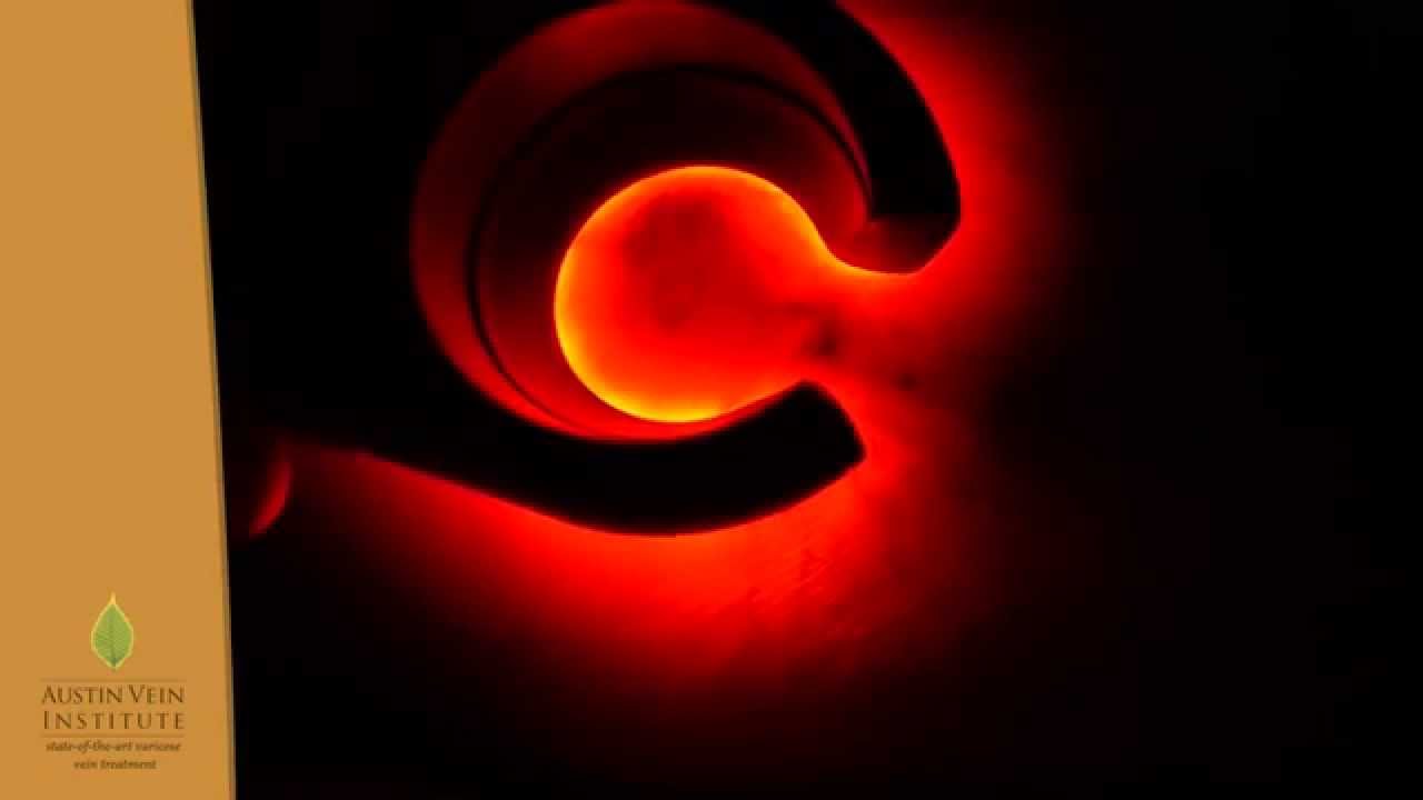 Light Guided Foam Sclerotherapy by Dr. Chris Brennig, Austin