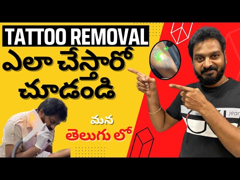 Tattoo Removal in Telugu | How to Remove a Tattoo | Tattoo Removal in Hyderabad | ND YAG Laser