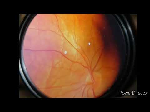 How to calculate CD ratio in glaucoma