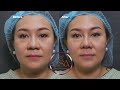 How to achieve a nose line make up effect w pdo nose threads  new rejuran healer for ageless skin