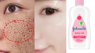 Johnson's baby oil for open pores home remedy | Open pores treatment | Get rid of open pores screenshot 4