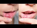 Mouth Ulcers: मुंह के छालों के लिए अपनाएं ये आसान रामबाण उपाय Mp3 Song