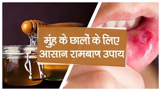 Mouth Ulcers: मुंह के छालों के लिए अपनाएं ये आसान रामबाण उपाय