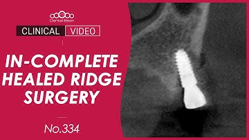Implant Placement on in-complete Healed Ridge [Dr. Jeon Inseong]