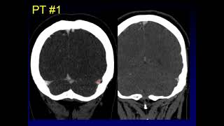 Mimics:  Dural Venous Sinus