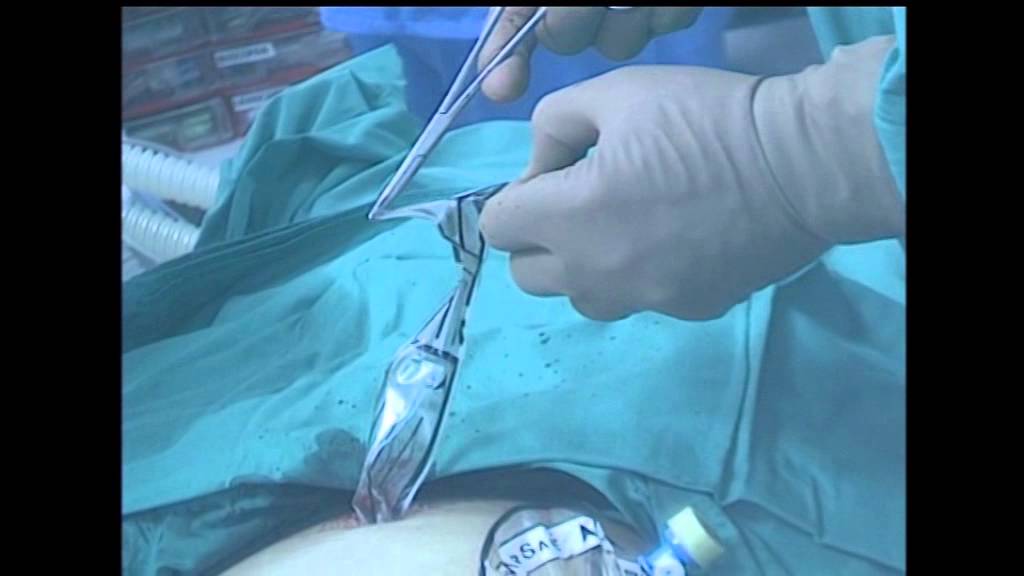 Laparoscopic Myomectomy with Morcellation within Morsafe
