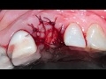 Fractura vertical dentaria